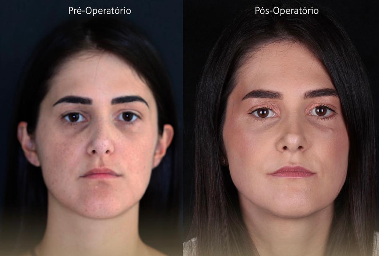 Antes e Depois Bucomaxilo em Franca