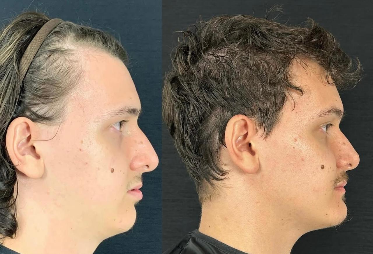 Antes e depois Bucomaxilo