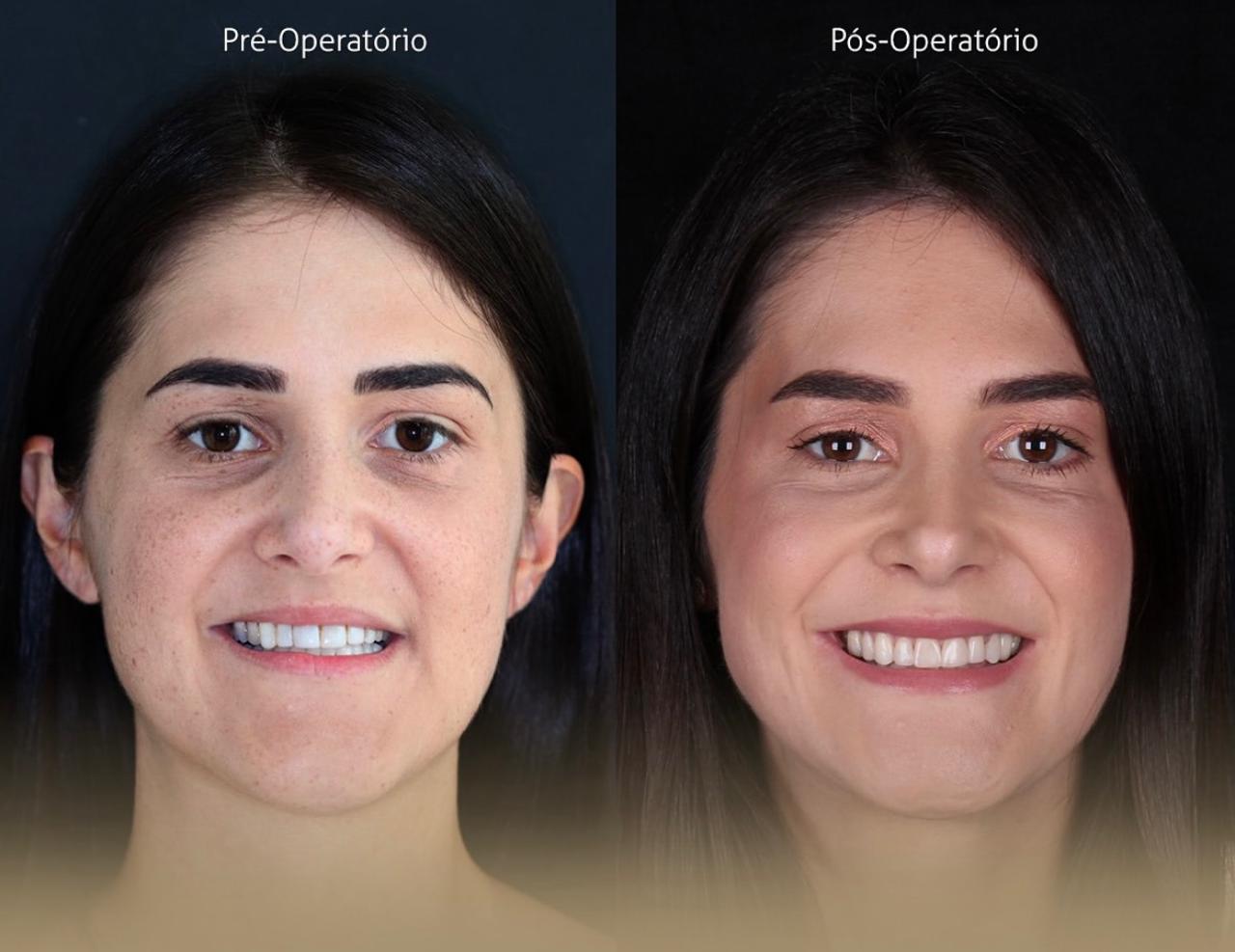 Bucomaxilo Franca SP Antes e Depois