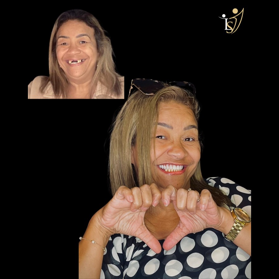 Implante Dental Antes e Depois