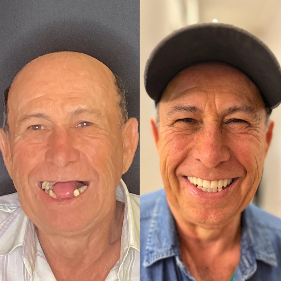 Implante Dentário Antes e Depois