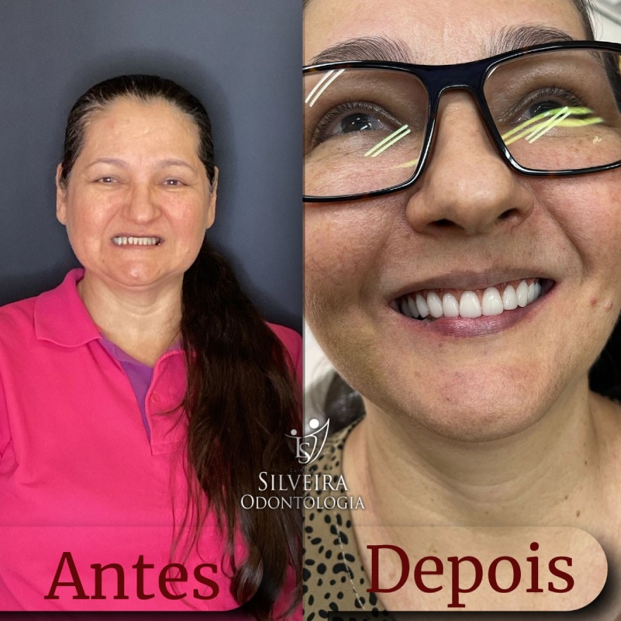 Implante de Dentes Antes e Depois