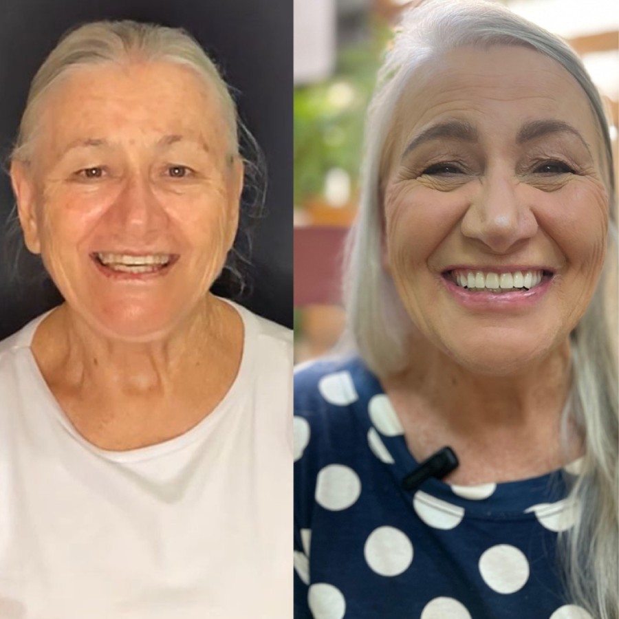 Prótese Dentária Antes e Depois