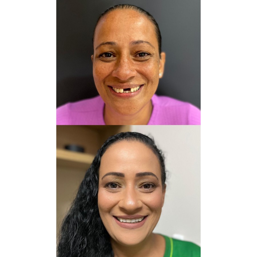 Prótese Protocolo Antes e Depois