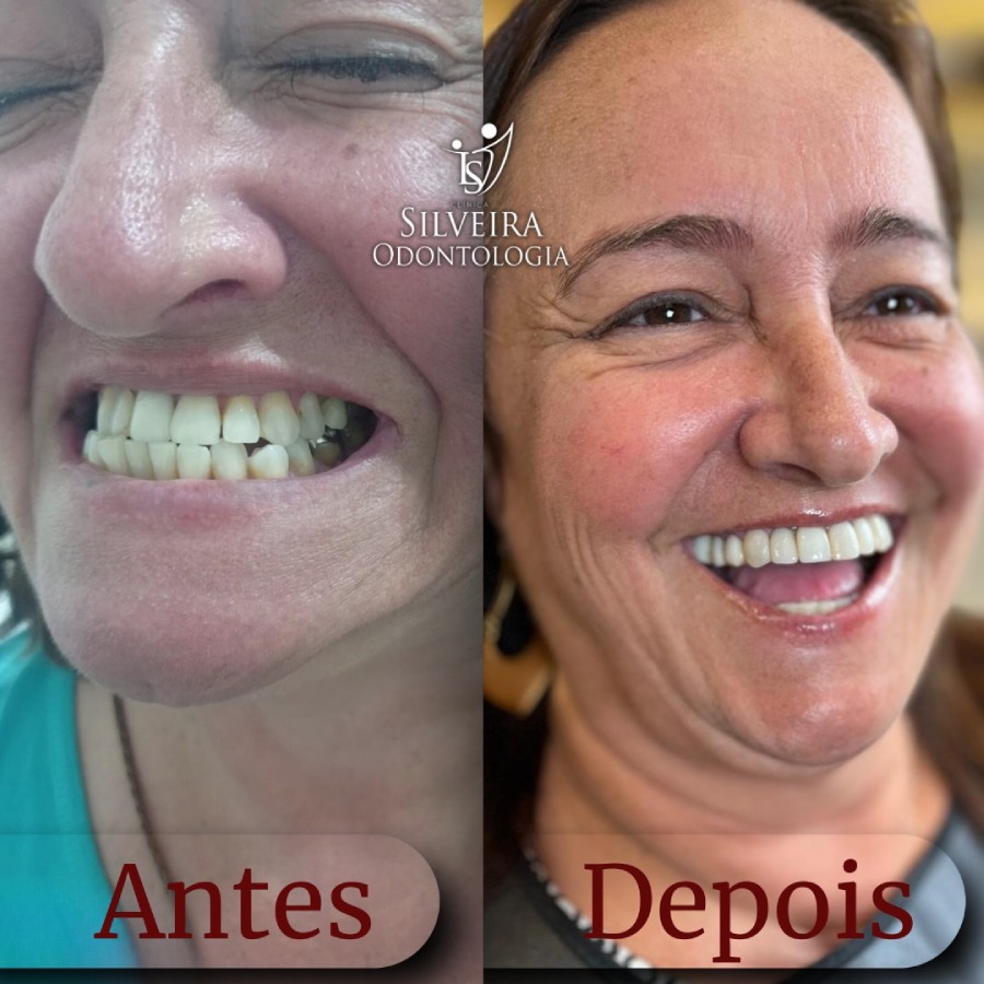 Prótese de Dentes Antes e Depois