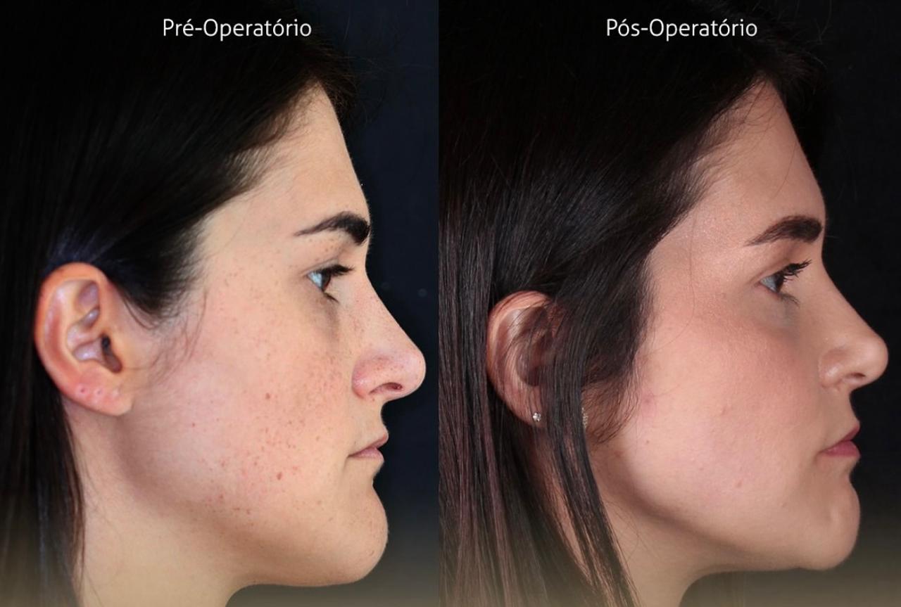 Mulher de perfil em antes e depois da cirurgia ortognática. A Silveira Odontologia em Franca orienta sobre a sensibilidade facial.